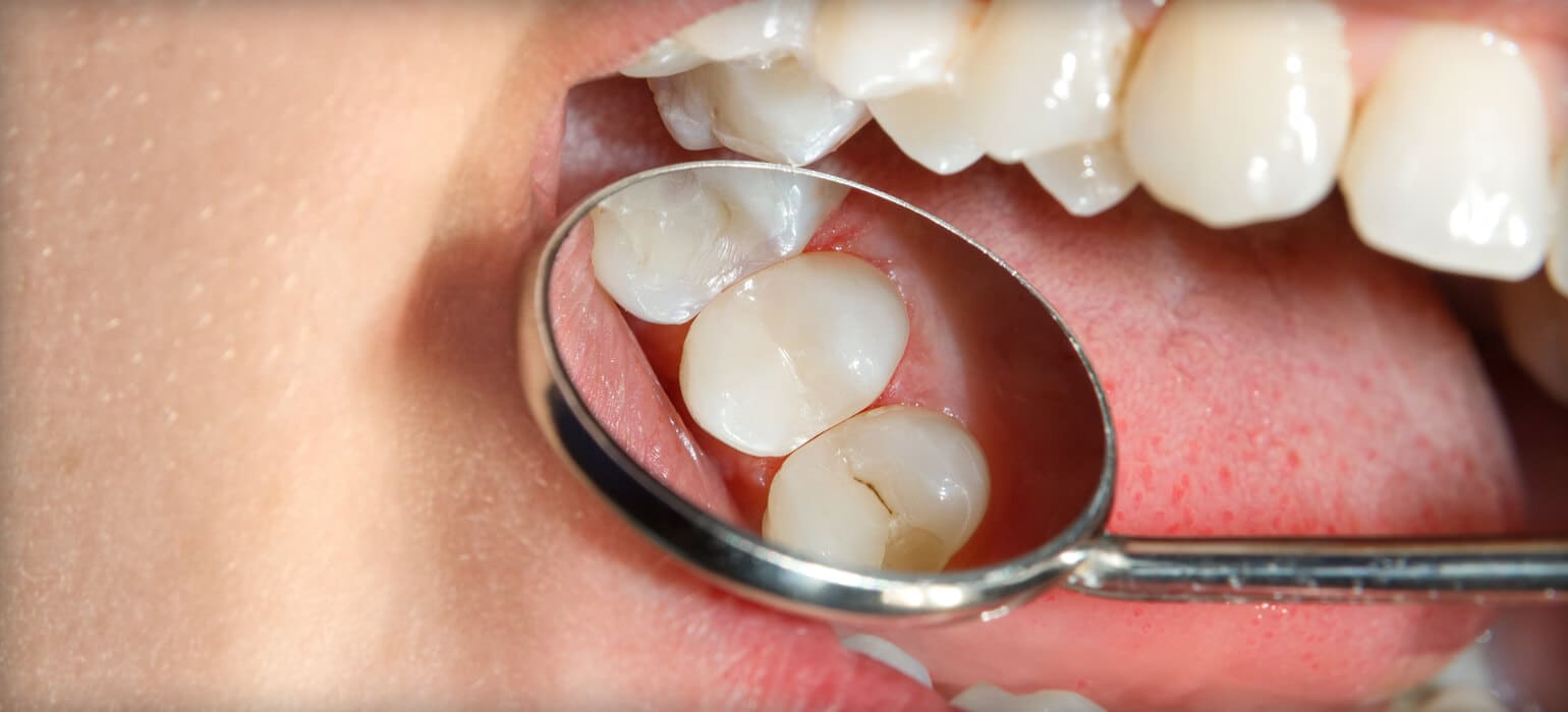 Dentalhealth Sealants Dentalhealth Sealants